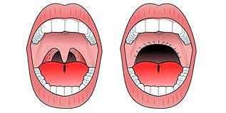 Uvulopalatopharyngoplasty surgery for snoring