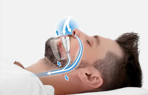 Open airway with VitalSleep