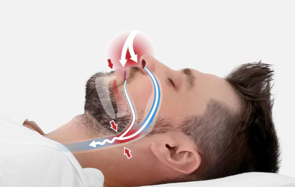 Restricted airway without VitalSleep
