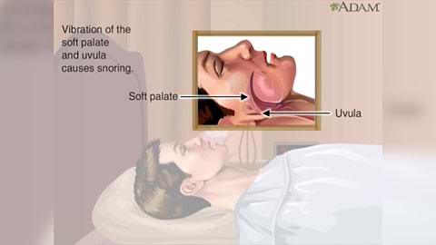 snoring diagram on how it is caused
