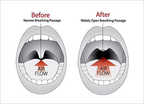 laser treatment for snoring