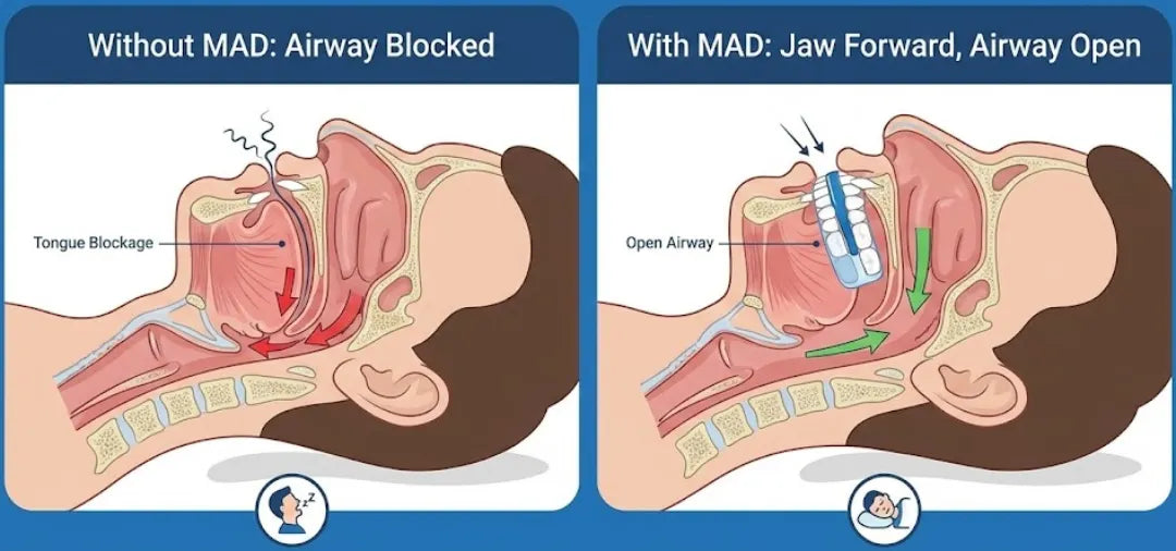 The Internal Solution: Mandibular Advancement Device