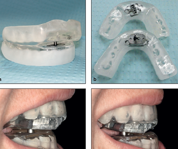 Best Mandibular Advancement Device for Sleep Apnea: Comprehensive Guide