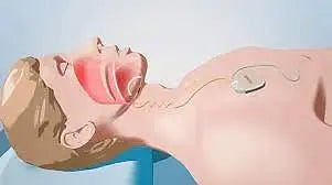 Inspire Therapy For Sleep Apnea - What Is It and How It Works