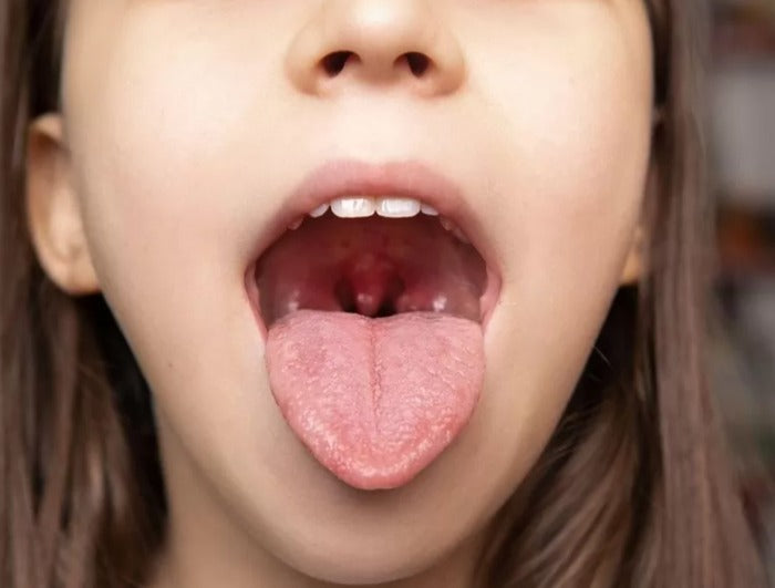 Can Swollen Tonsils Cause Snoring?