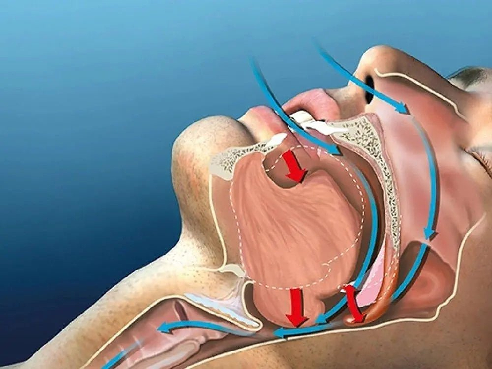 My Story On How I Stopped Snoring With My Own Invention
