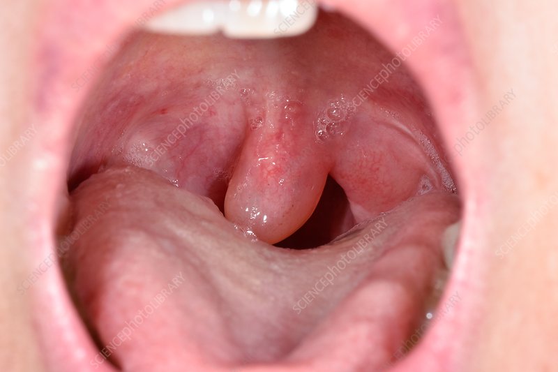 swollen uvula snoring