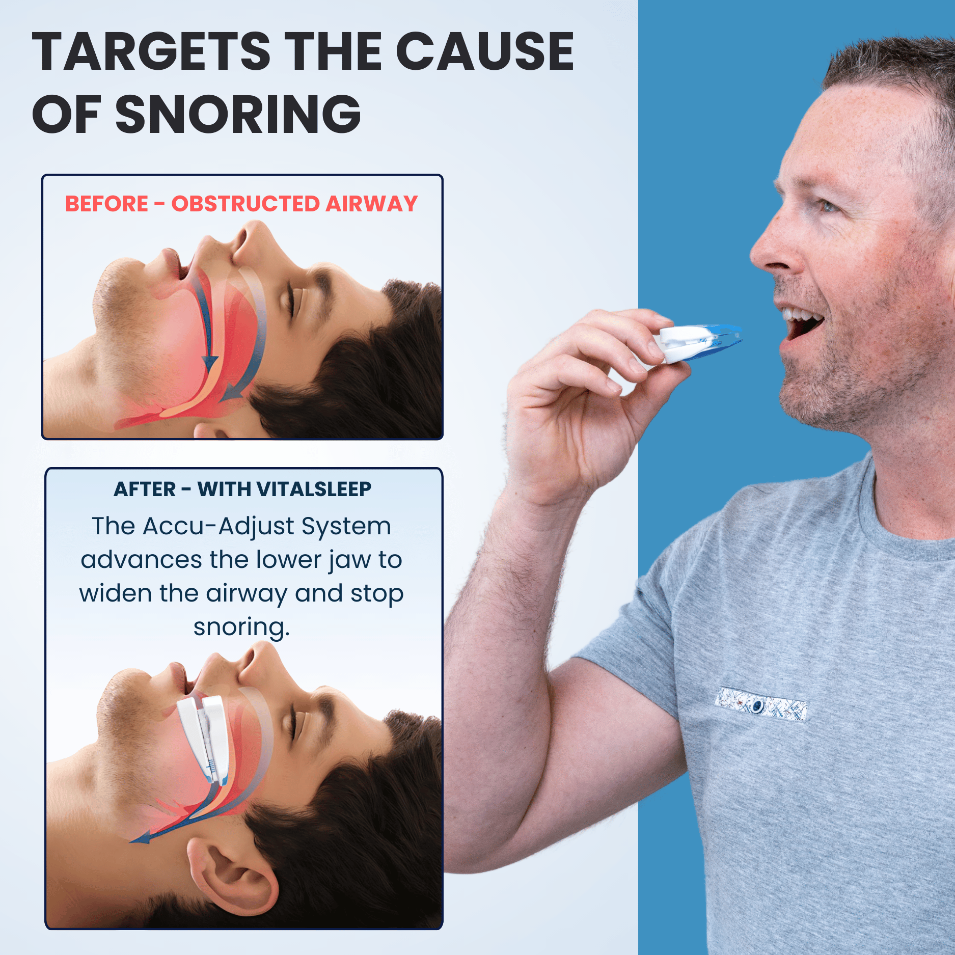 Snoring mouthguard designed for personalized fit