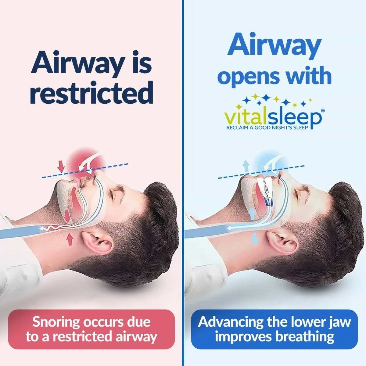 פייס נגד נחירות VitalSleep snoring device