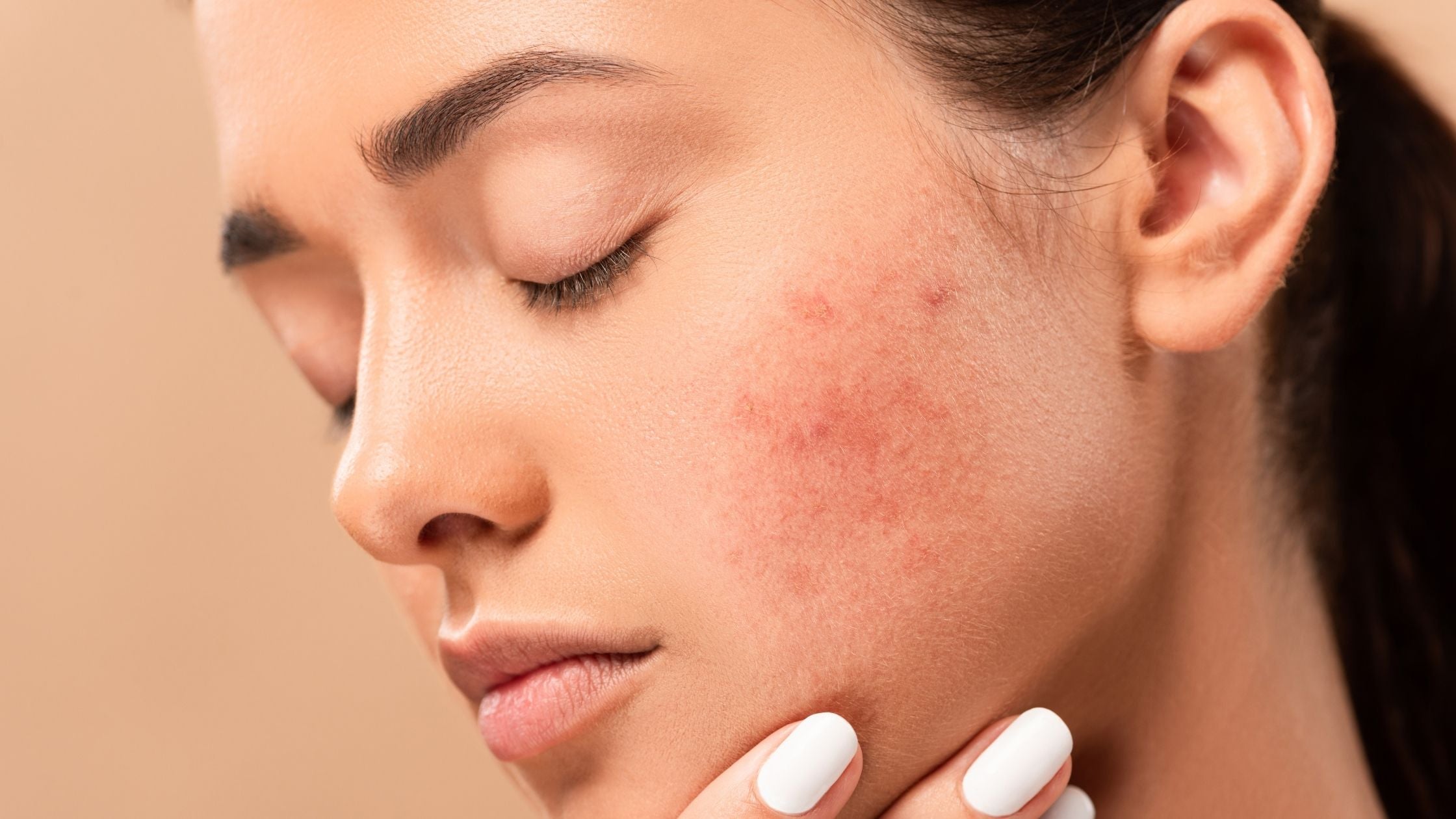 What is hormonal acne?