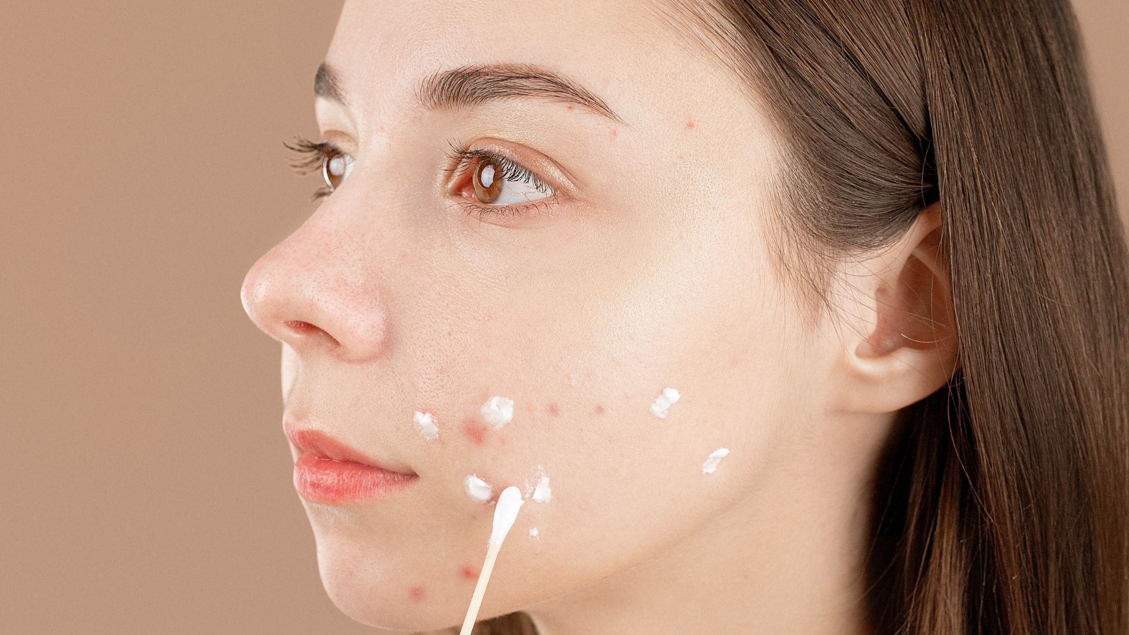 how Retinoids can help