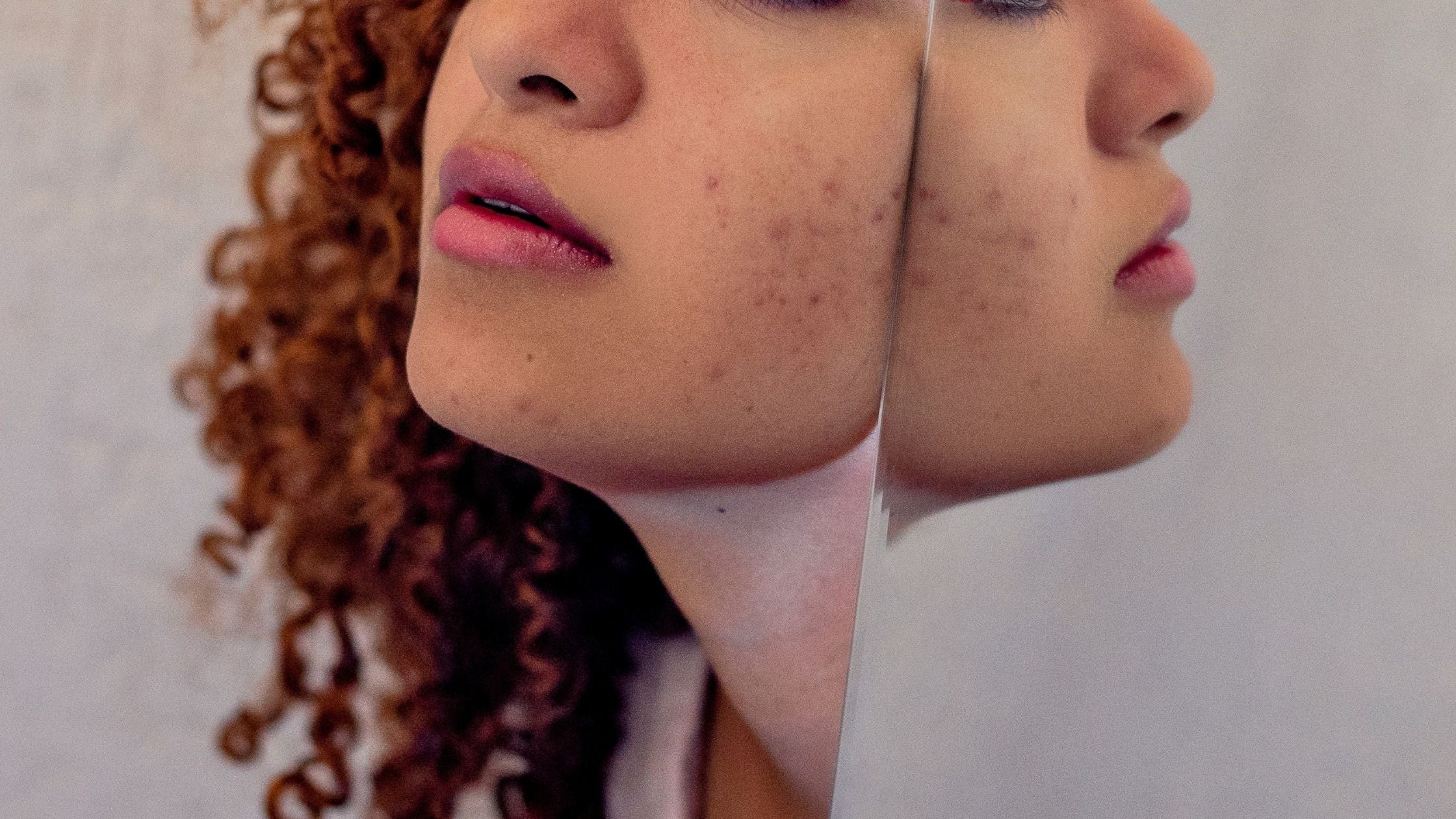 How Do Acne Spot Patches Work For Skin