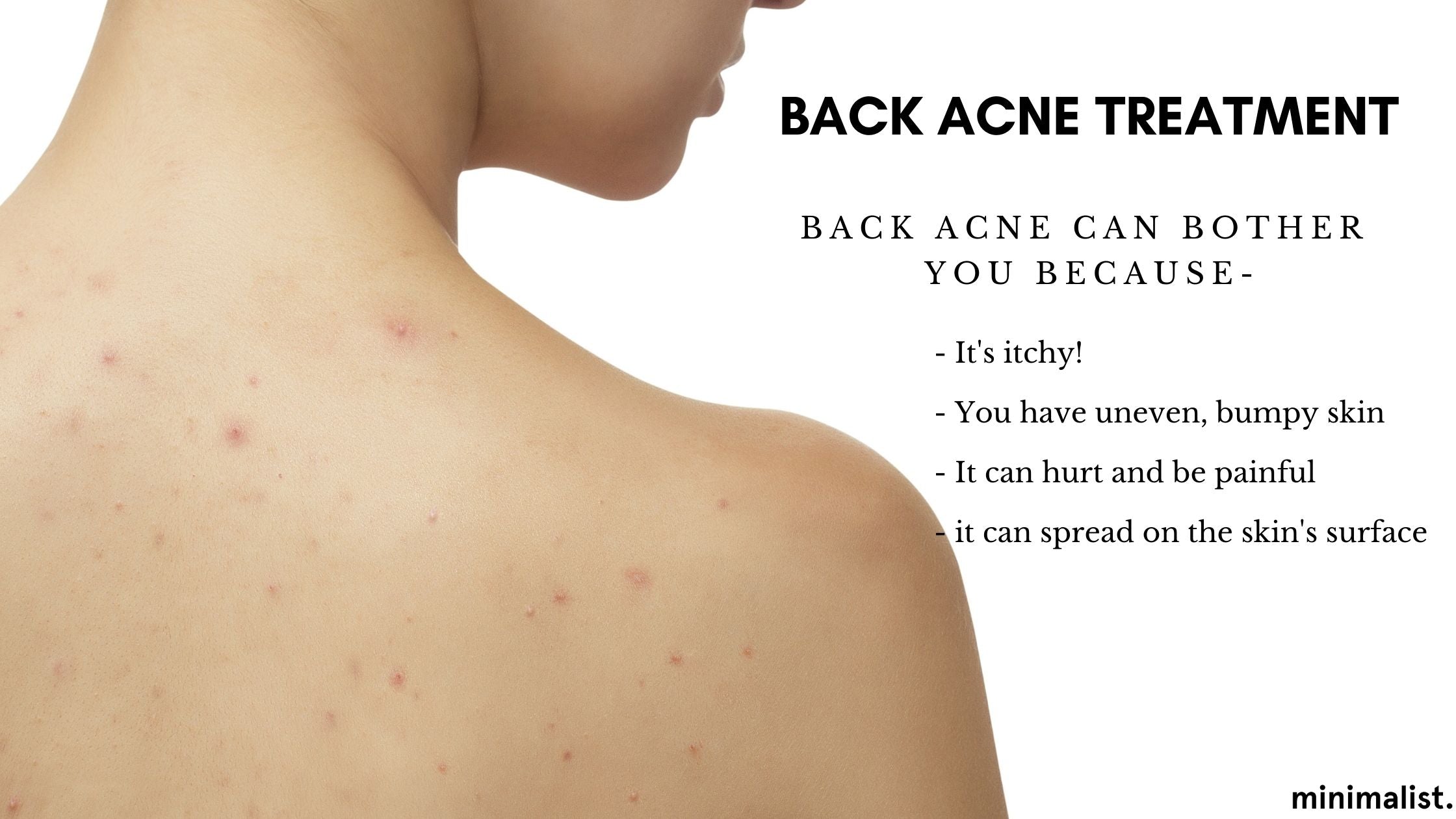 Back Rash Acne Back Acne: Causes, Treatment & Prevention – Minimalist