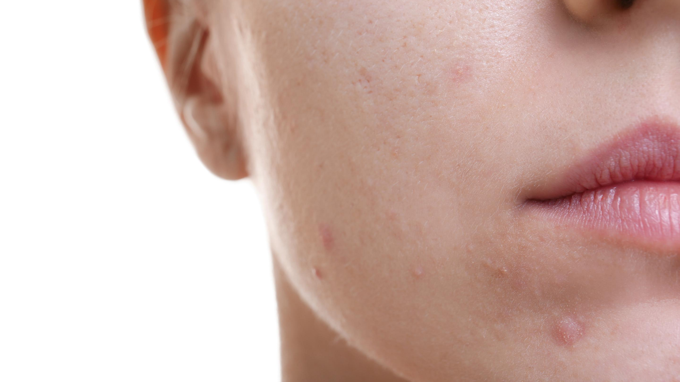 Acne Vulgaris