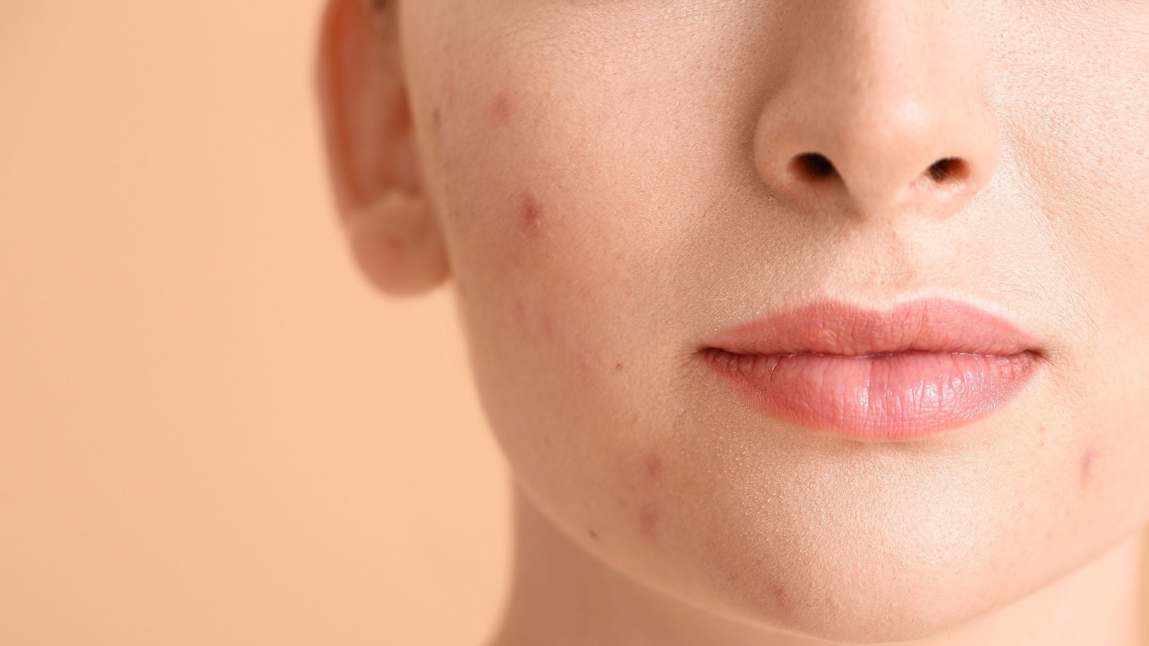 Spot Treatment for acne