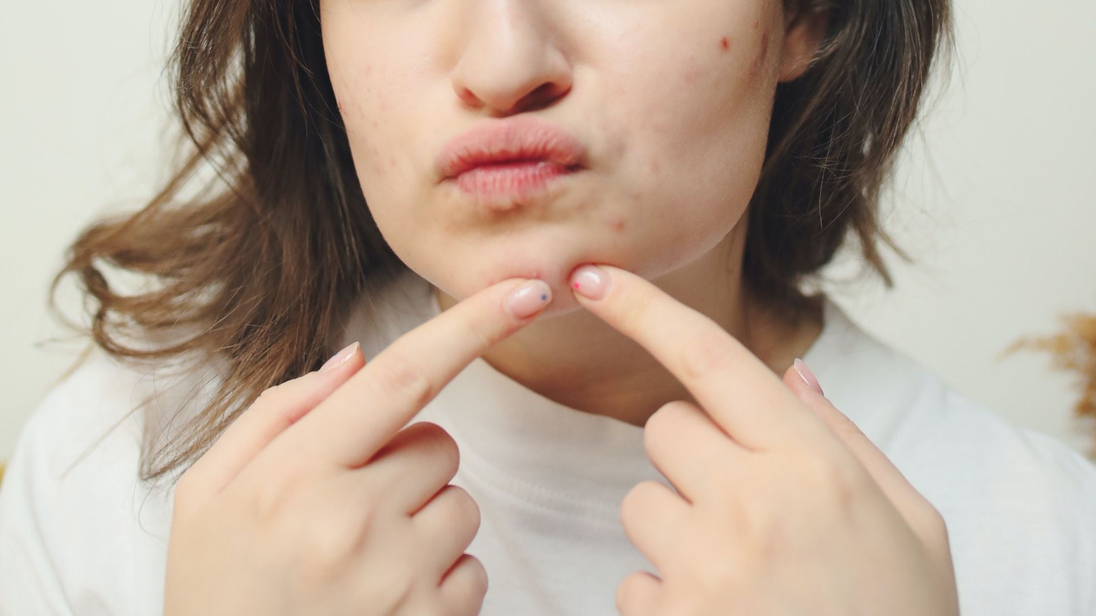 How does Salicylic Acid help Acne-Prone Skin?