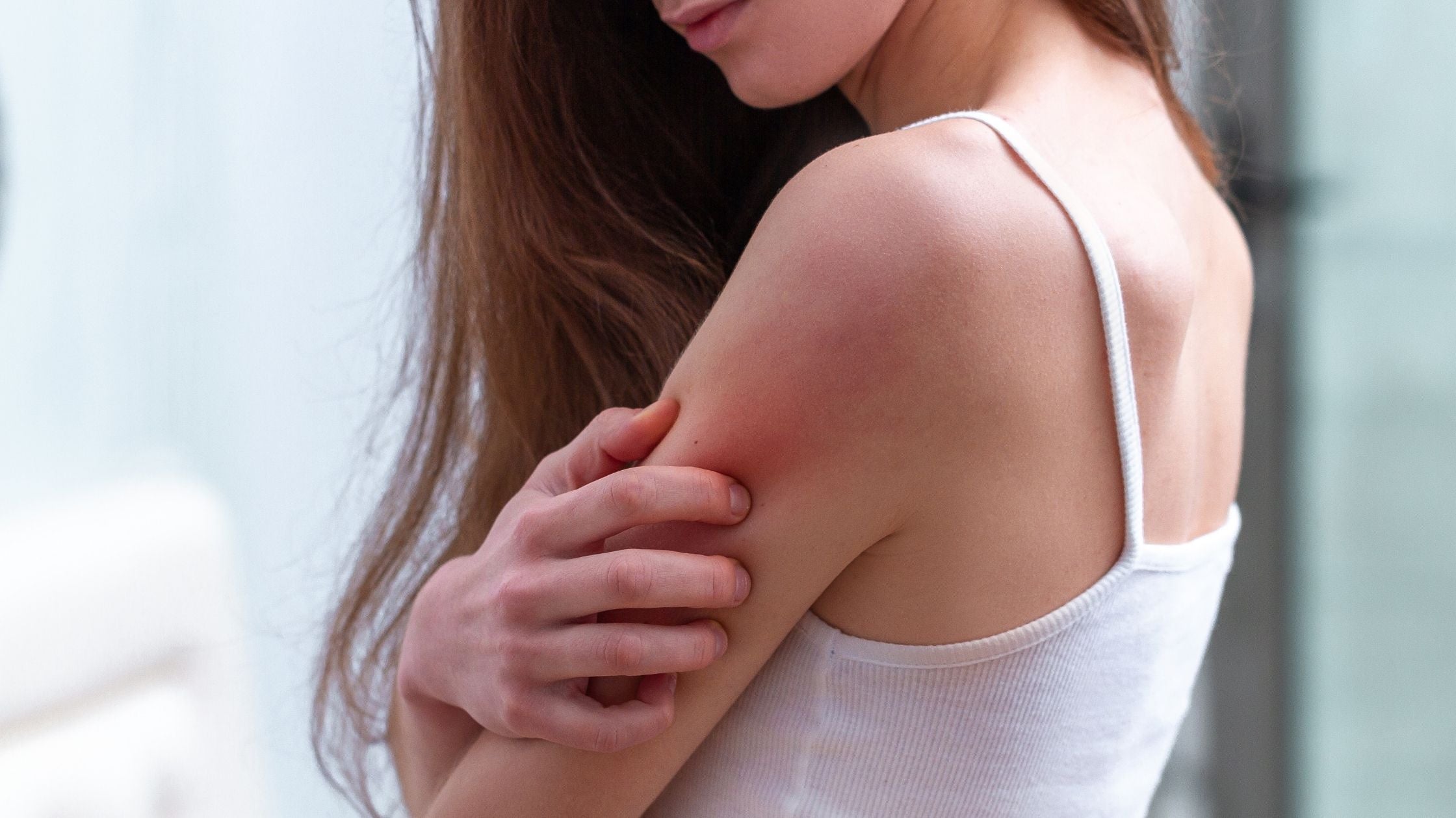 How to Avoid and Treat Heat Rashes