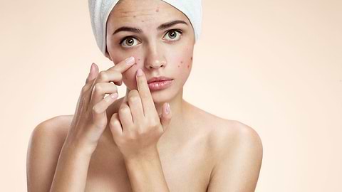 Can Acne Cause Hyperpigmentation?