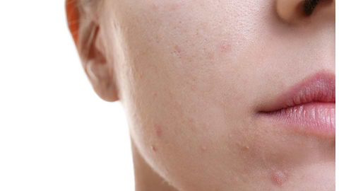 What is Acne Vulgaris? Causes, Symptoms & Treatments