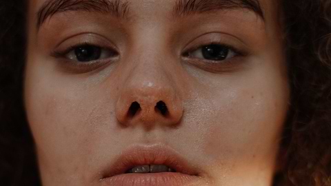 Benefits of Niacinamide for Acne - Can it really help?