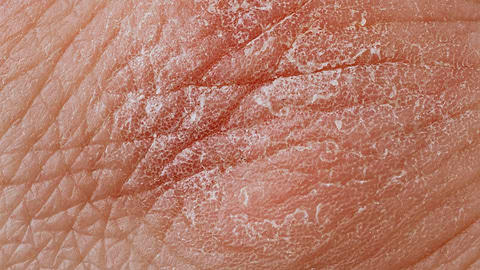 Is Psoriasis a Serious Skin Condition?