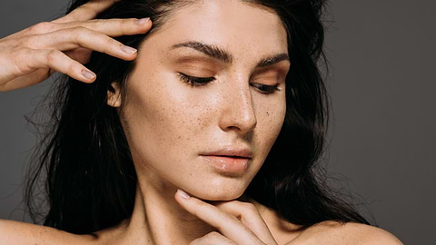 What are Freckles? How are they caused and how to treat them?