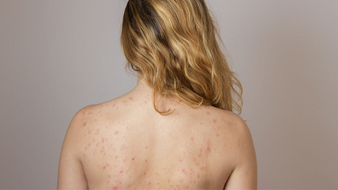 Salicylic Acid Body Wash - How it Works and Who Should Use It?
