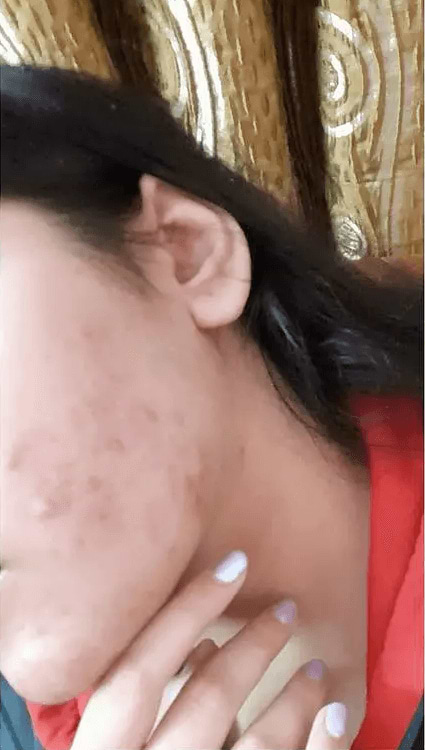 Analyze skin after Acne