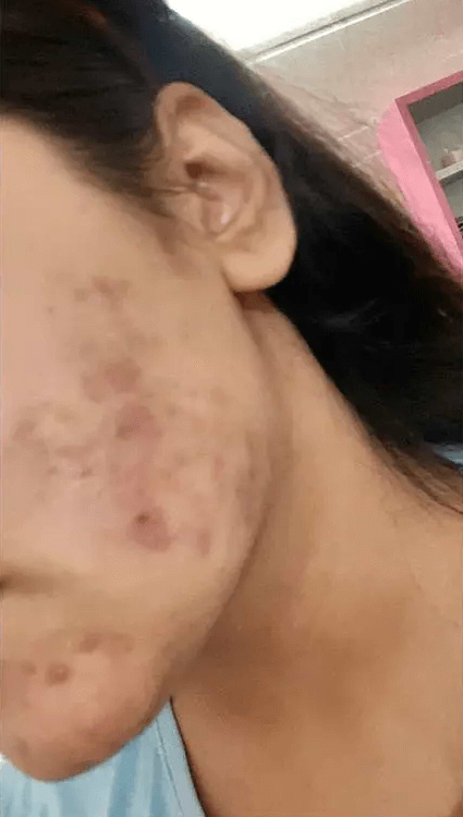 Analyze skin before Acne