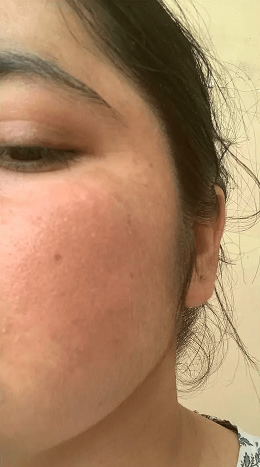 Analyze skin after Pigmentation