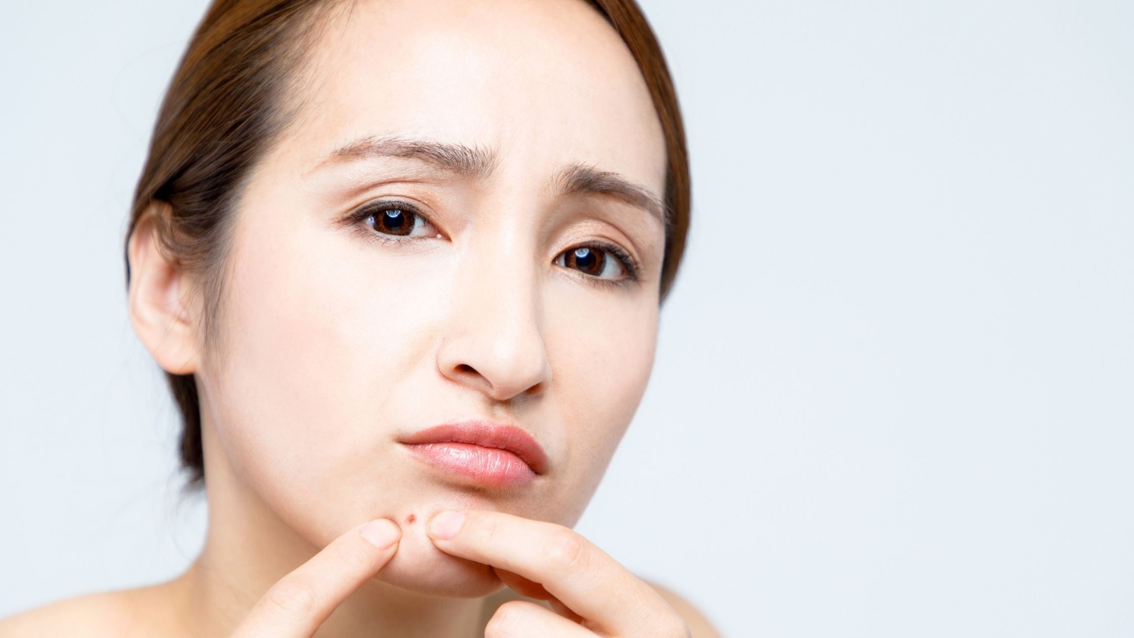 how you can ditch chin acne