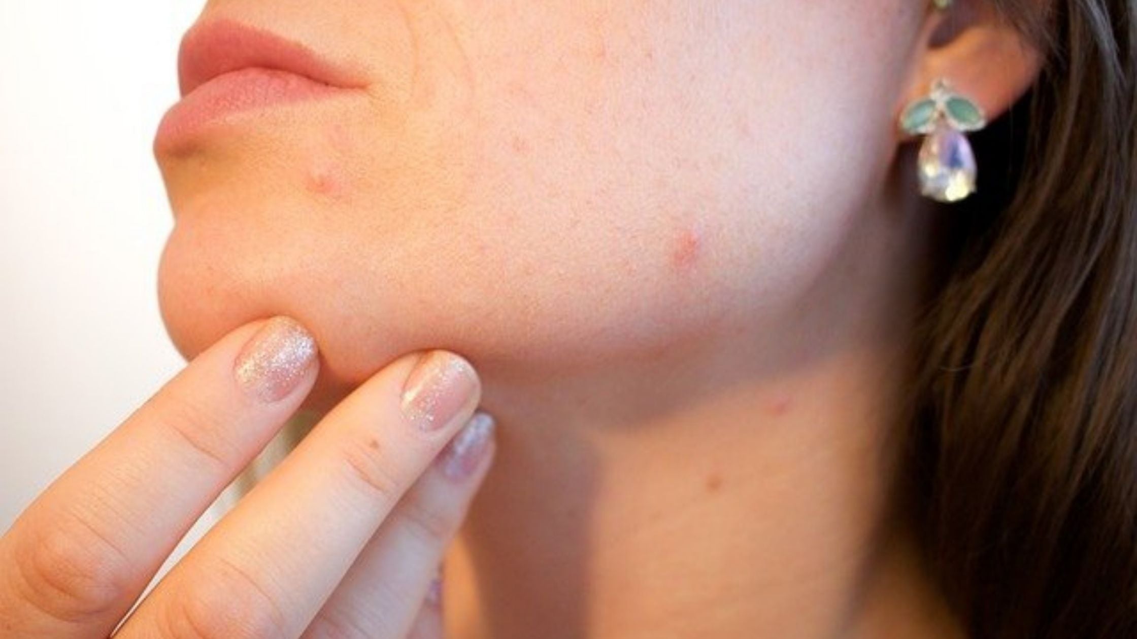 good moisturizer for acne-prone skin