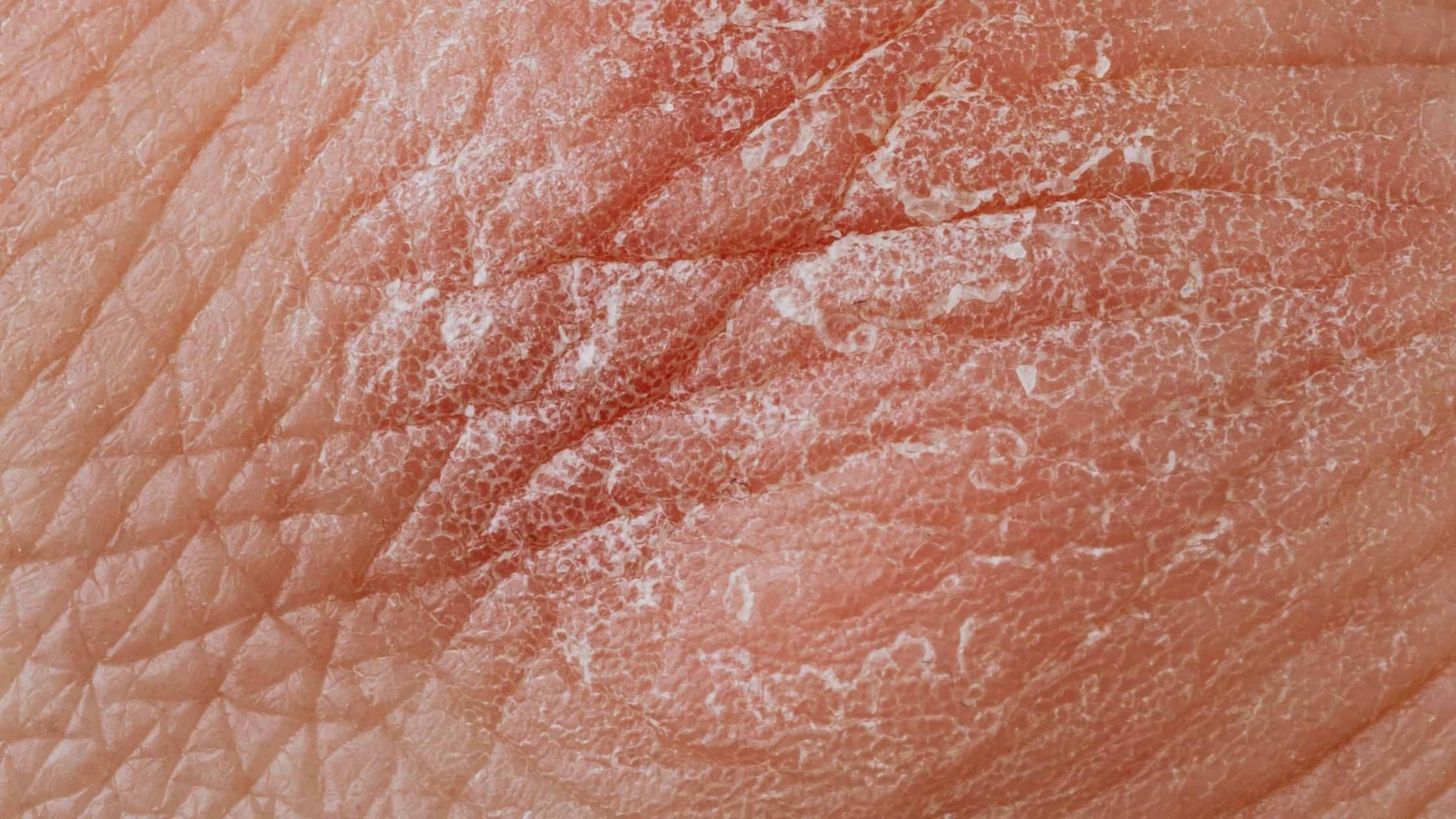 Is Psoriasis a Serious Skin Condition?