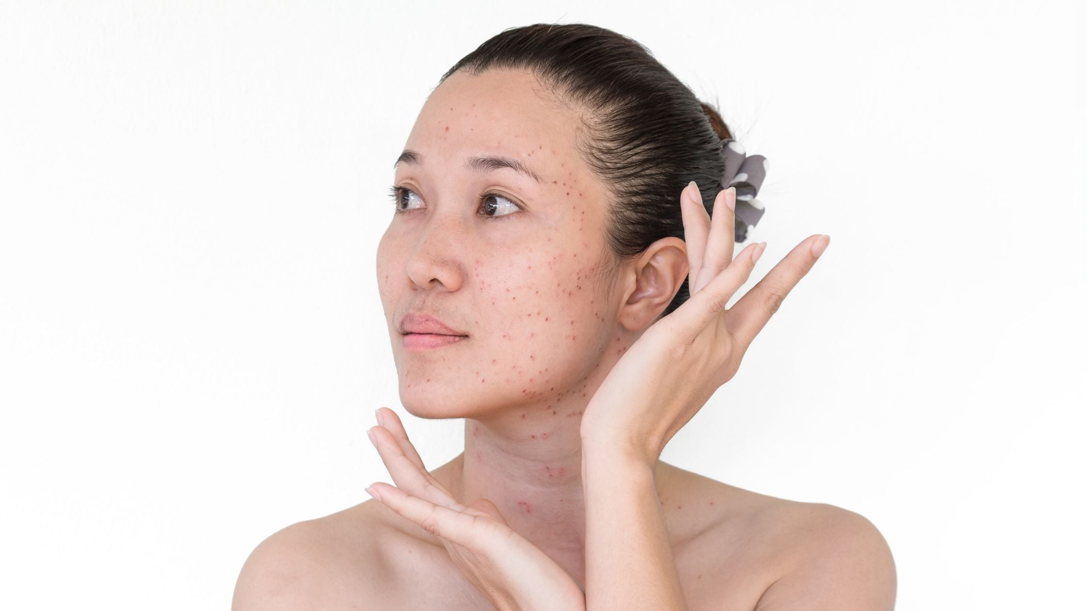How to remove & prevent Age spots?