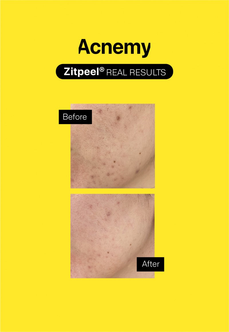 ZITPEEL® Sanftes Peeling bei Akne