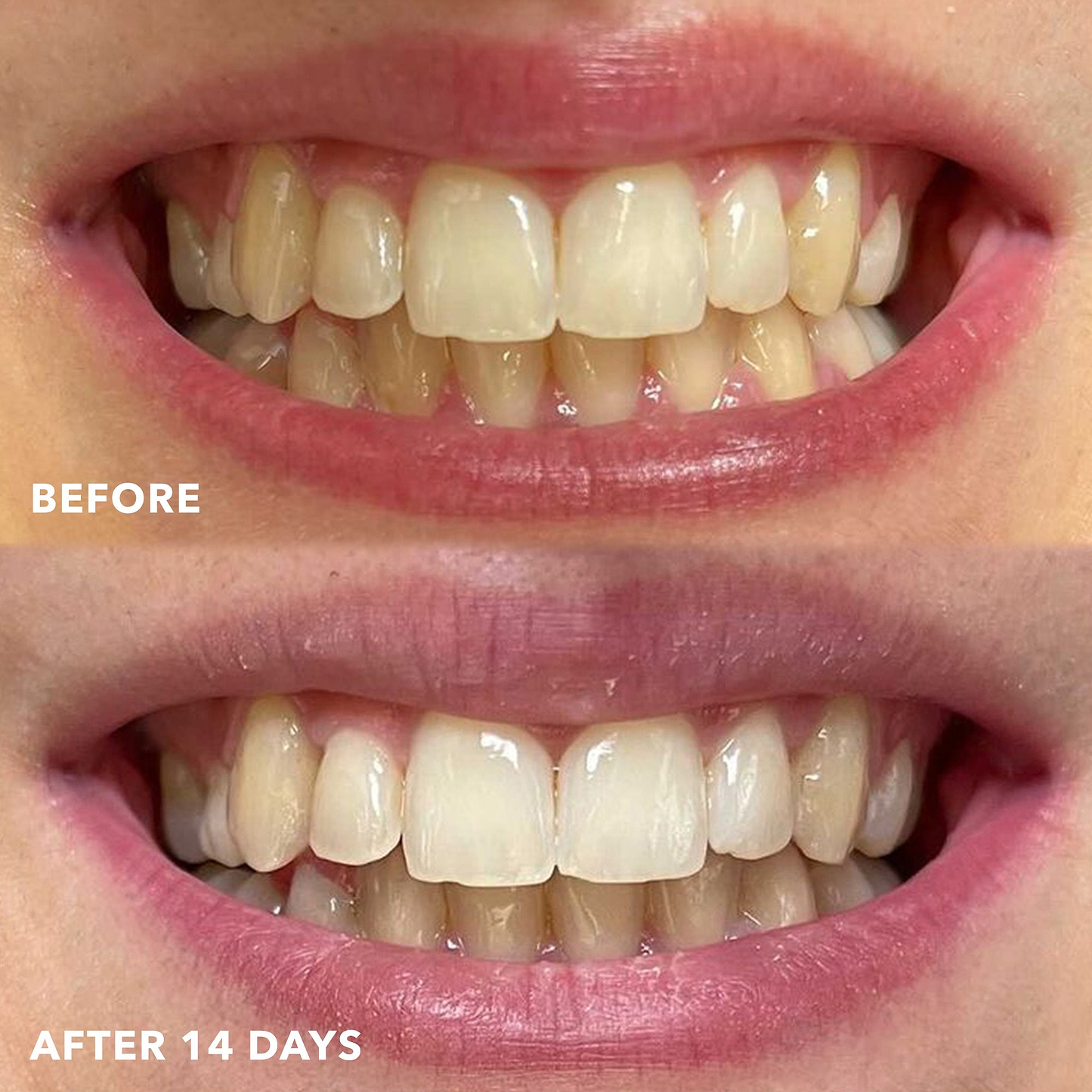 Teeth Whitening Strips