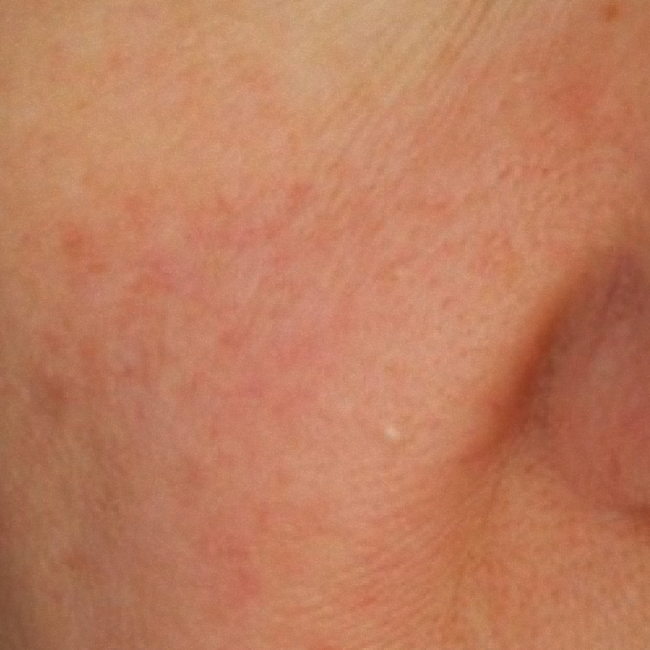 close-up of womans face before using Madara sos + sensitive moisturiser