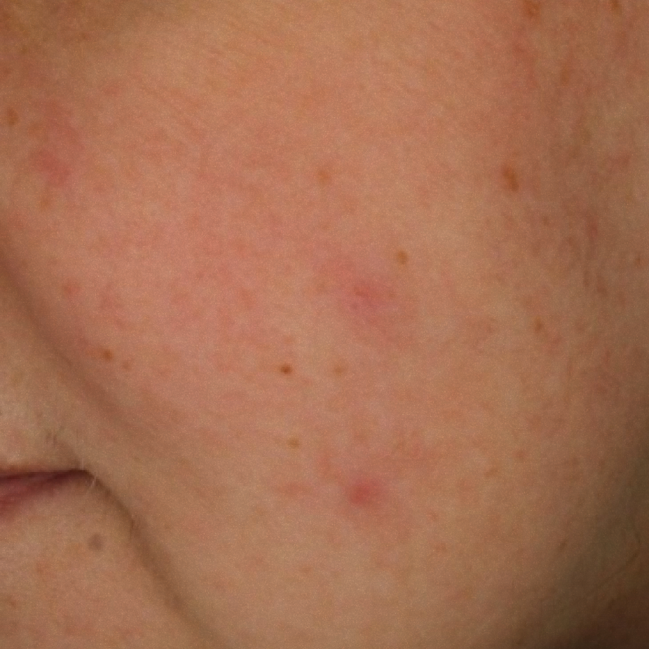 close-up of womans face before using Madara sos + sensitive night cream