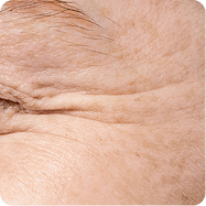 Fine lines & Wrinkles