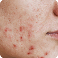 Acne