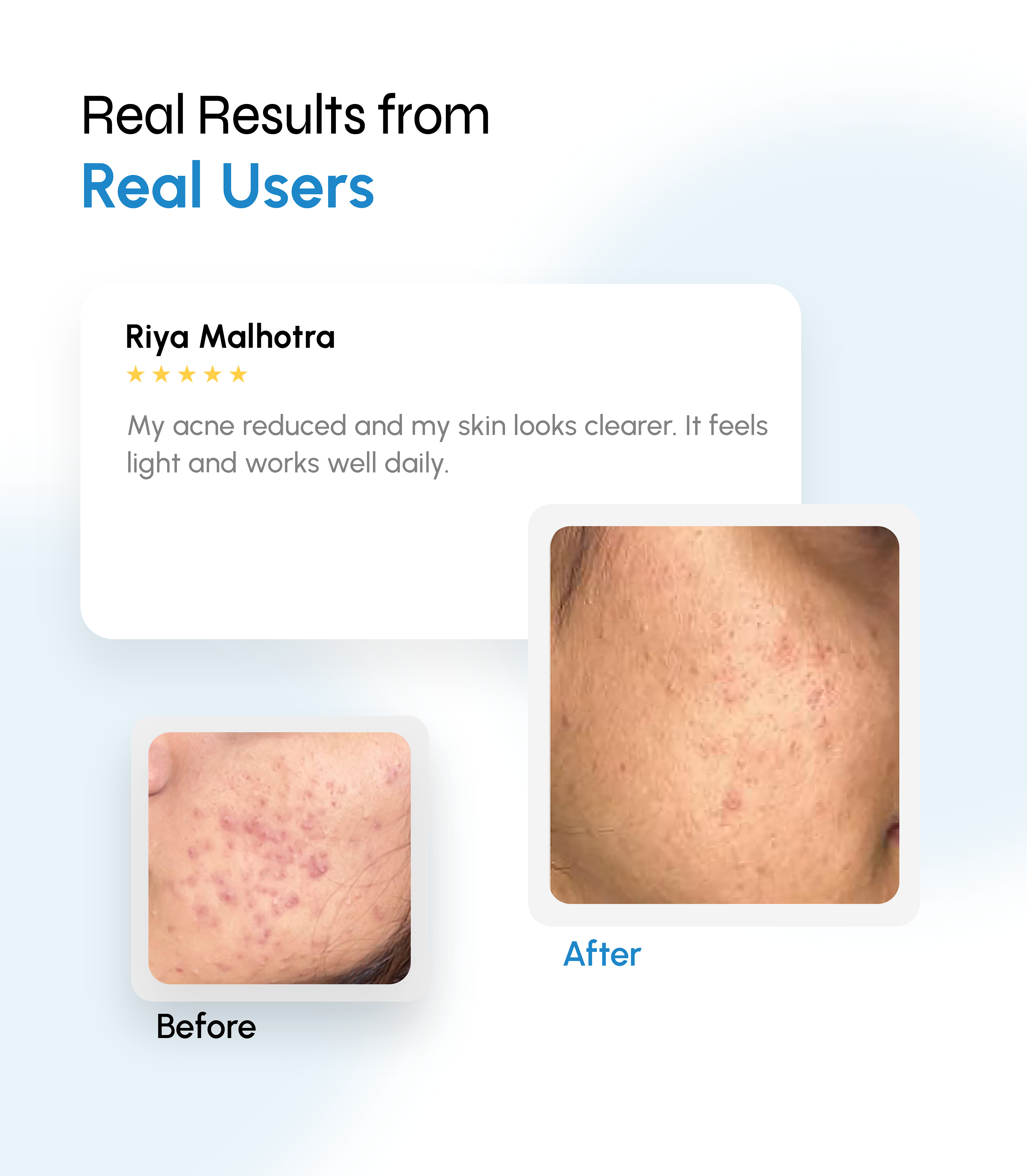 Multi-Action Acne Defense Face Serum